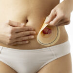 Cuidado de ostomía: cómo limpiar el estoma, cambiar la bolsa y prevenir complicaciones. Guía práctica para pacientes y personal de salud en Guatemala.